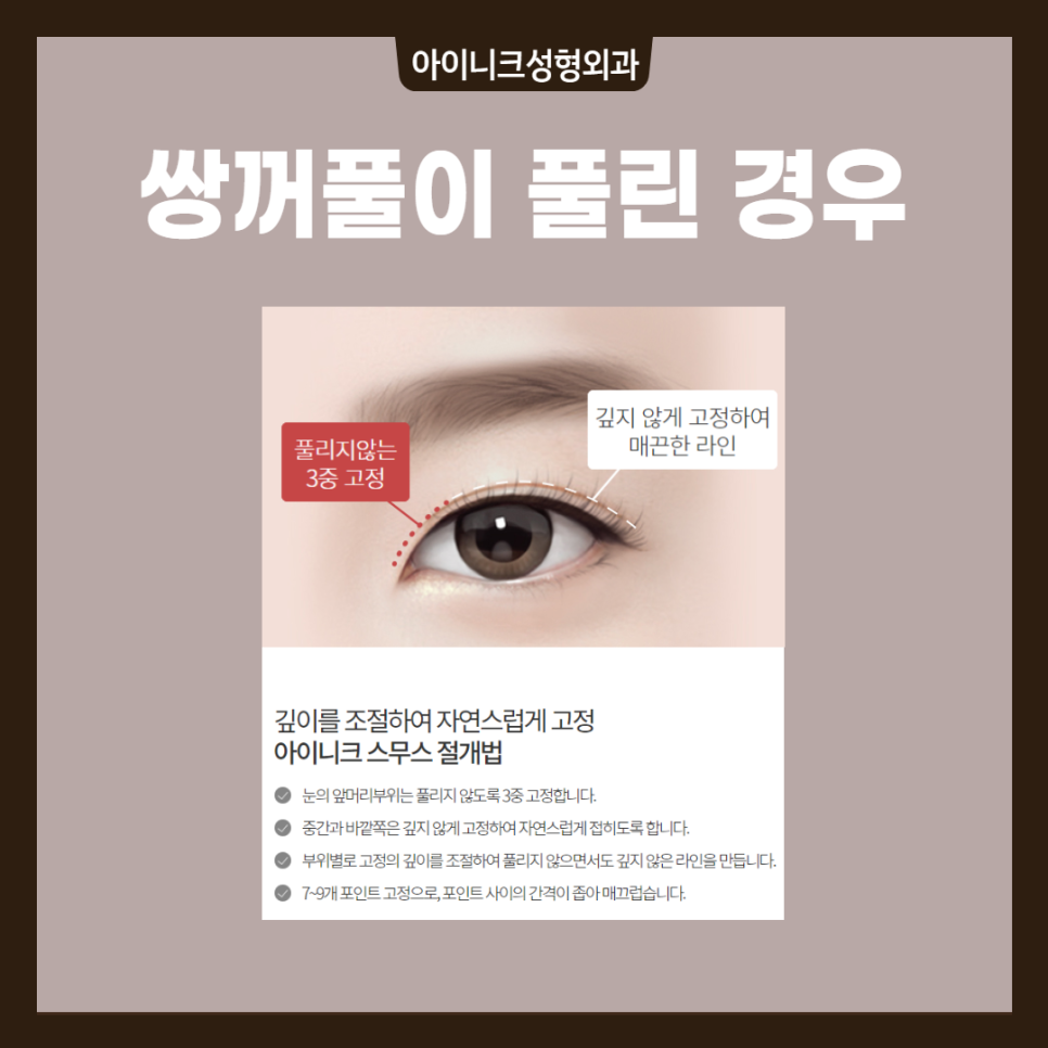 겹쌍꺼풀 해결방법, 원인에 따른 플랜이 필요해요! 관련 이미지 3