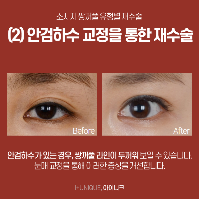 What Should You Do About Uncomfortable Sausage-Like Double Eyelids? image 4