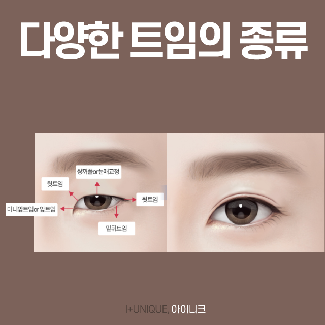 뒤트임성형 이제 더 이상 고민하지 마세요! 관련 이미지 2