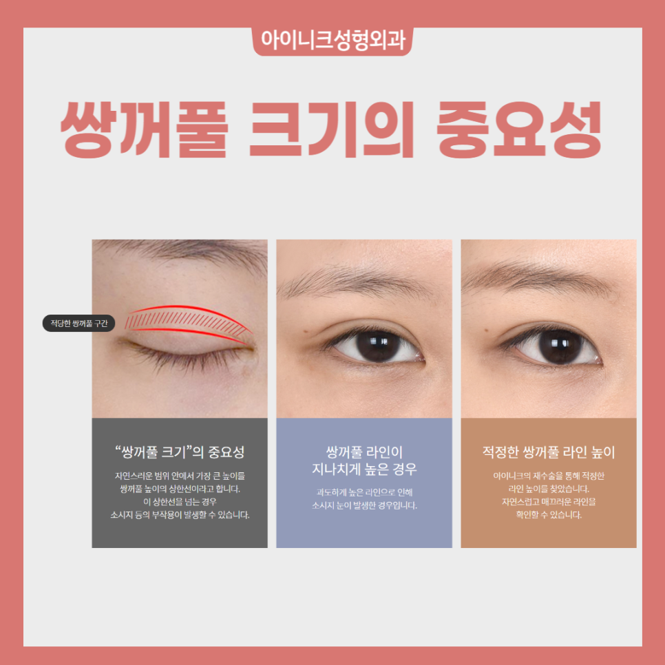 자연스러운 남자무쌍눈매를 원한다면 관련 이미지 3
