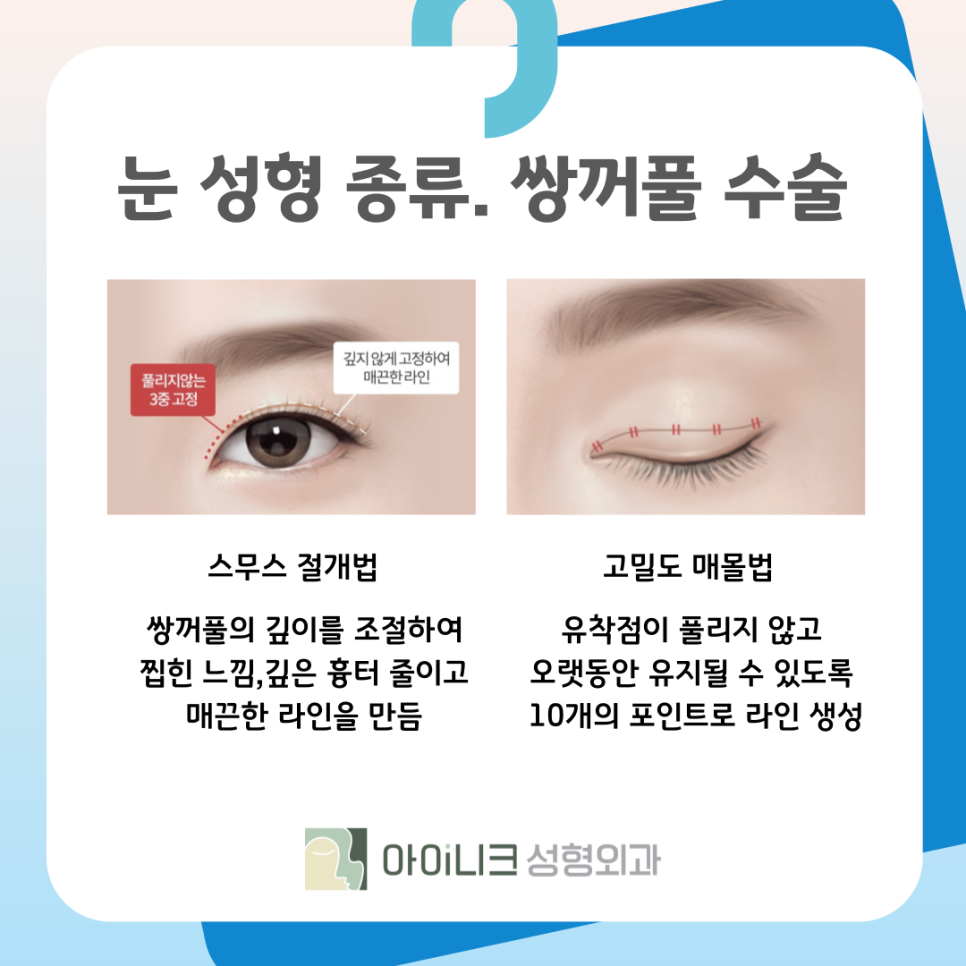 강남성형외과유명한곳 눈 성형 종류가 궁금해요 관련 이미지 6