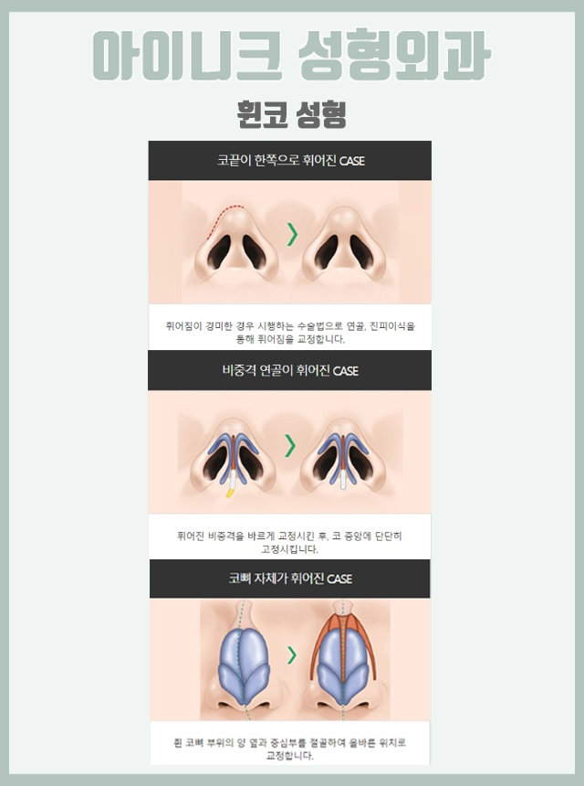 화살코성형후기 정면, 측면 모두 완벽하게! 관련 이미지 7