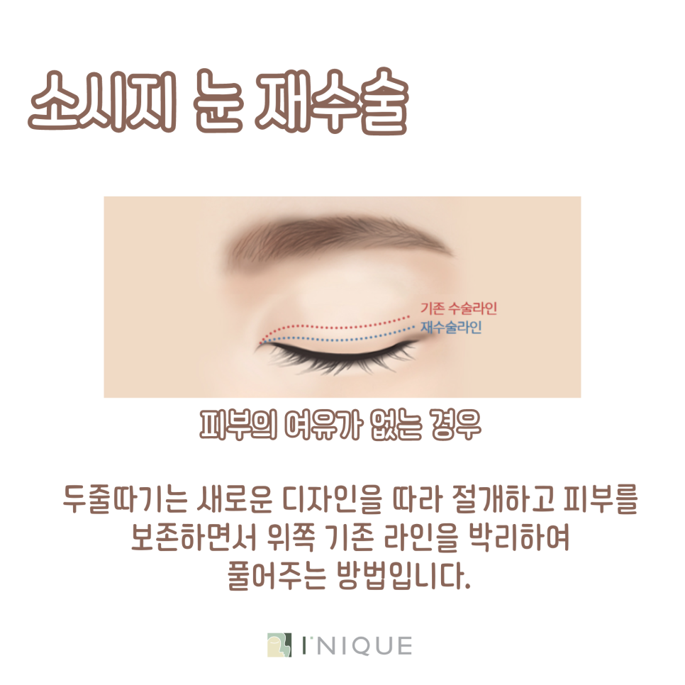 쌍꺼풀재수술성공 하고 싶다면 관련 이미지 3