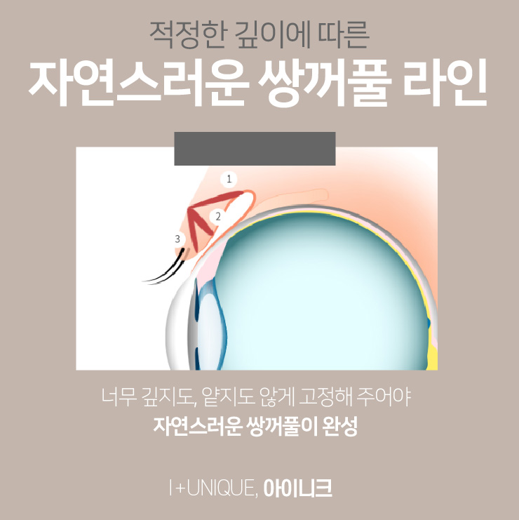한쪽눈쌍꺼풀이 고민이라면 아이니크에서 알아보자 관련 이미지 3