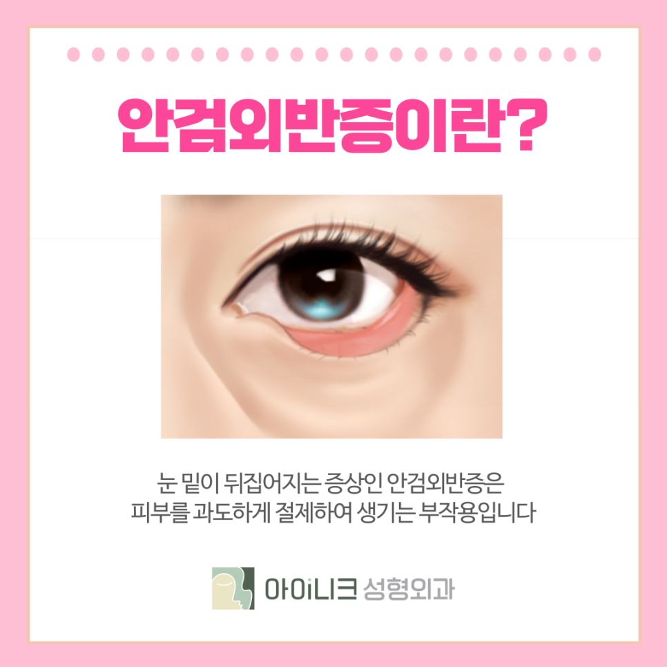 압구정 중년눈성형 시간을 되돌리고 싶다면? 관련 이미지 7
