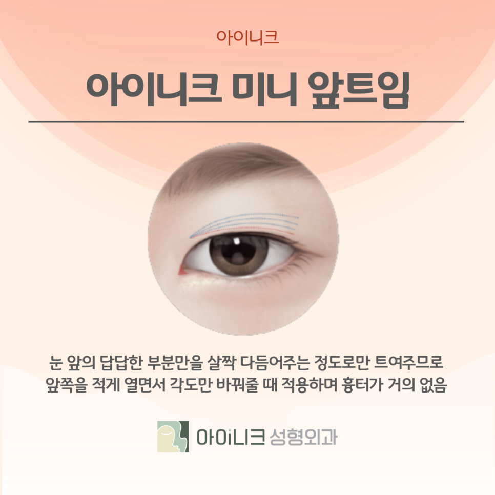 압구정성형외과 앞트임으로 크고 예쁜 눈 관련 이미지 10