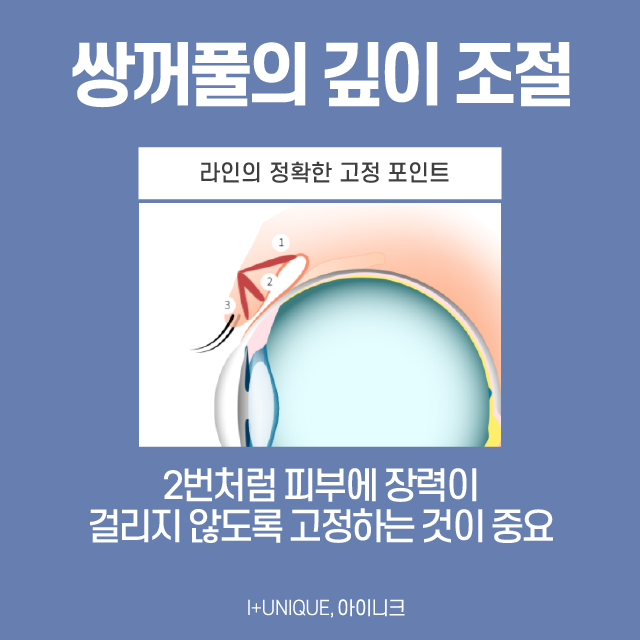 쌍꺼풀수술흉터 없이 성공하는 방법 관련 이미지 4
