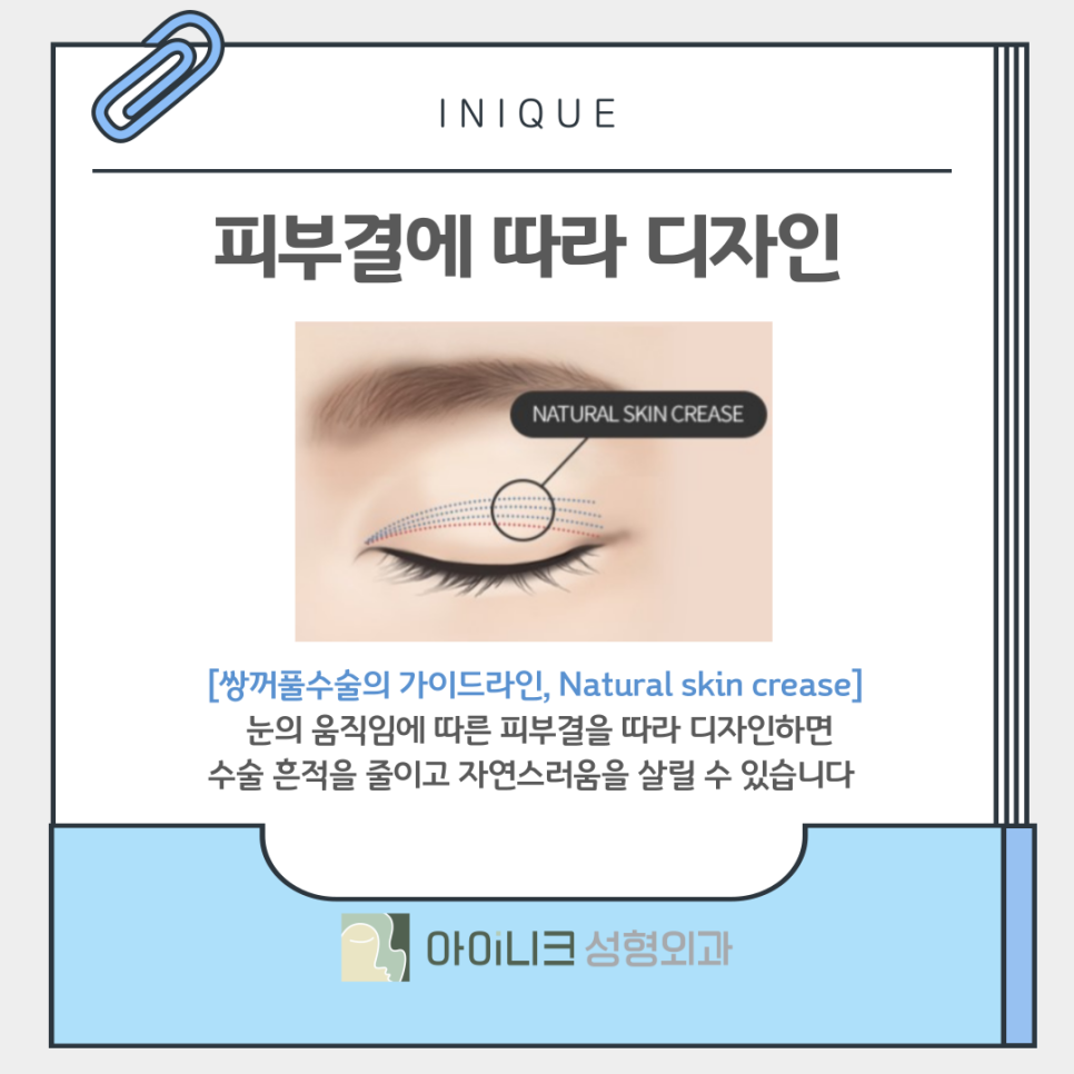 Double Eyelid Surgery: How Can You Create Clear, Beautiful Eyes? image 10