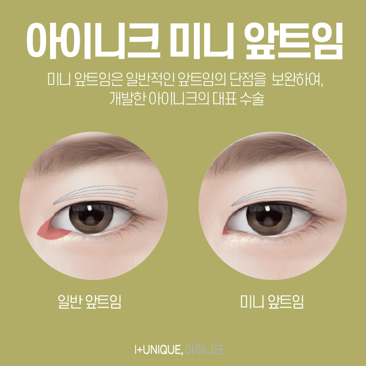 앞트임수술 알아보고 있다면 내 눈을 철저하게 분석해 주는 곳으로! 관련 이미지 3