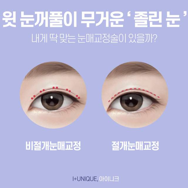 비절개눈매교정 수술로 첫인상 바꾸기 관련 이미지 2