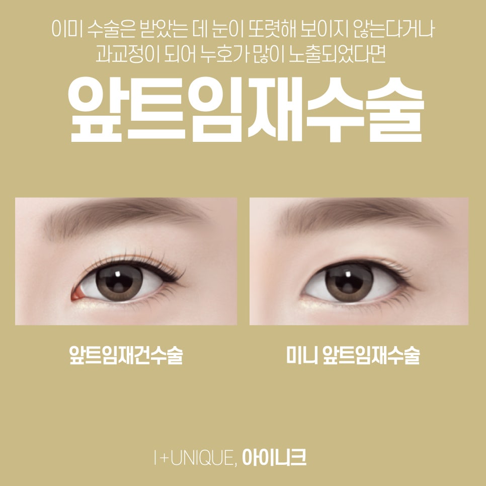 앞트임성형도 자연스럽게 아이니크성형외과에서 관련 이미지 4
