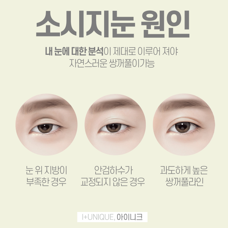 눈재수술추천을 알아보고 있다면 바로 여기 아이니크성형외과 관련 이미지 3