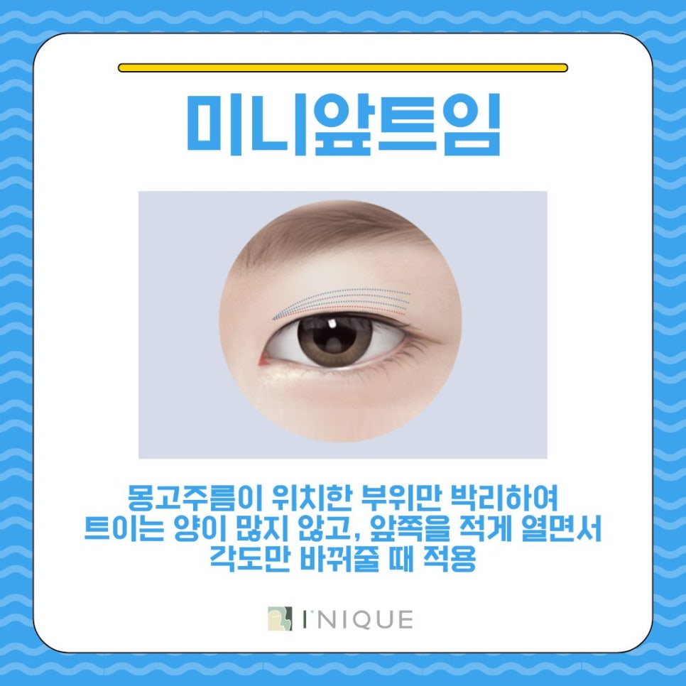 작은눈성형, 이게 답이다! 관련 이미지 6