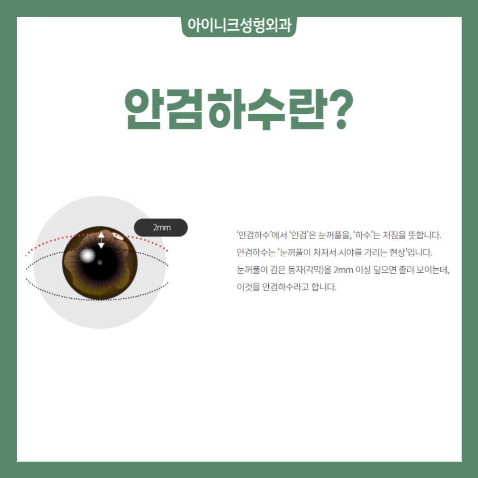 짝눈눈매교정 어떻게 해야 하나요? 관련 이미지 3