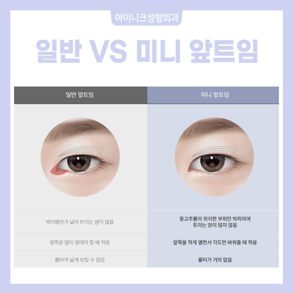눈트임수술종류 다양하게 알아보고 선택하자! 관련 이미지 3