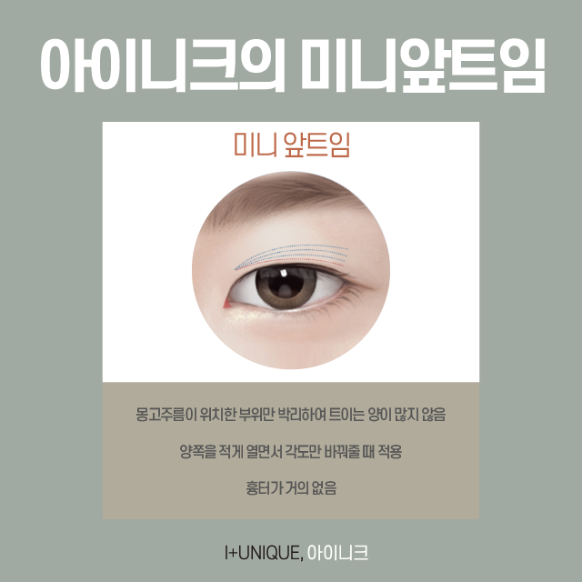 Learn About the Surgical Methods for Gangnam Epicanthoplasty and Eye Shape Correction image 4