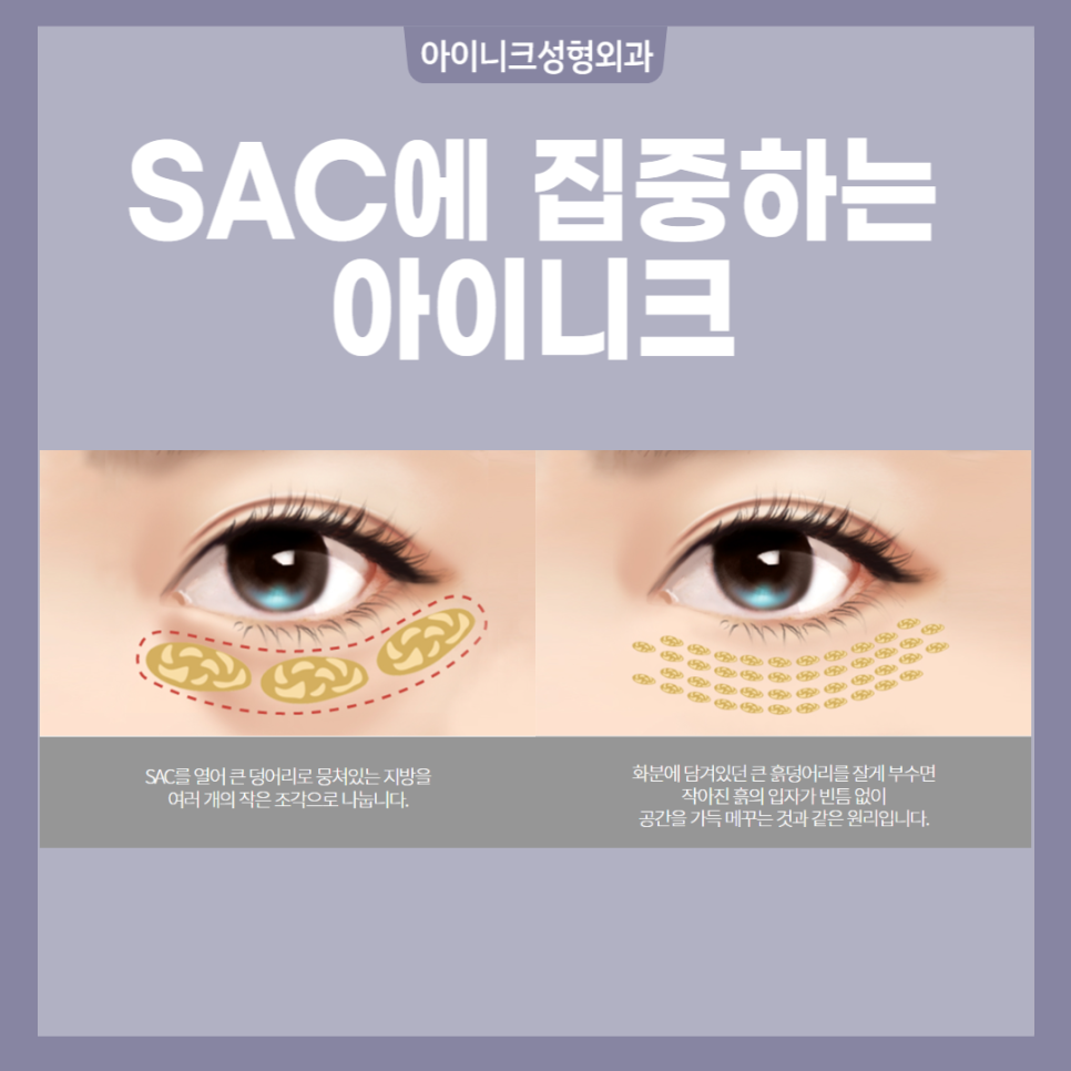 다크써클수술 생기 있는 얼굴로 되돌아가자! 관련 이미지 3