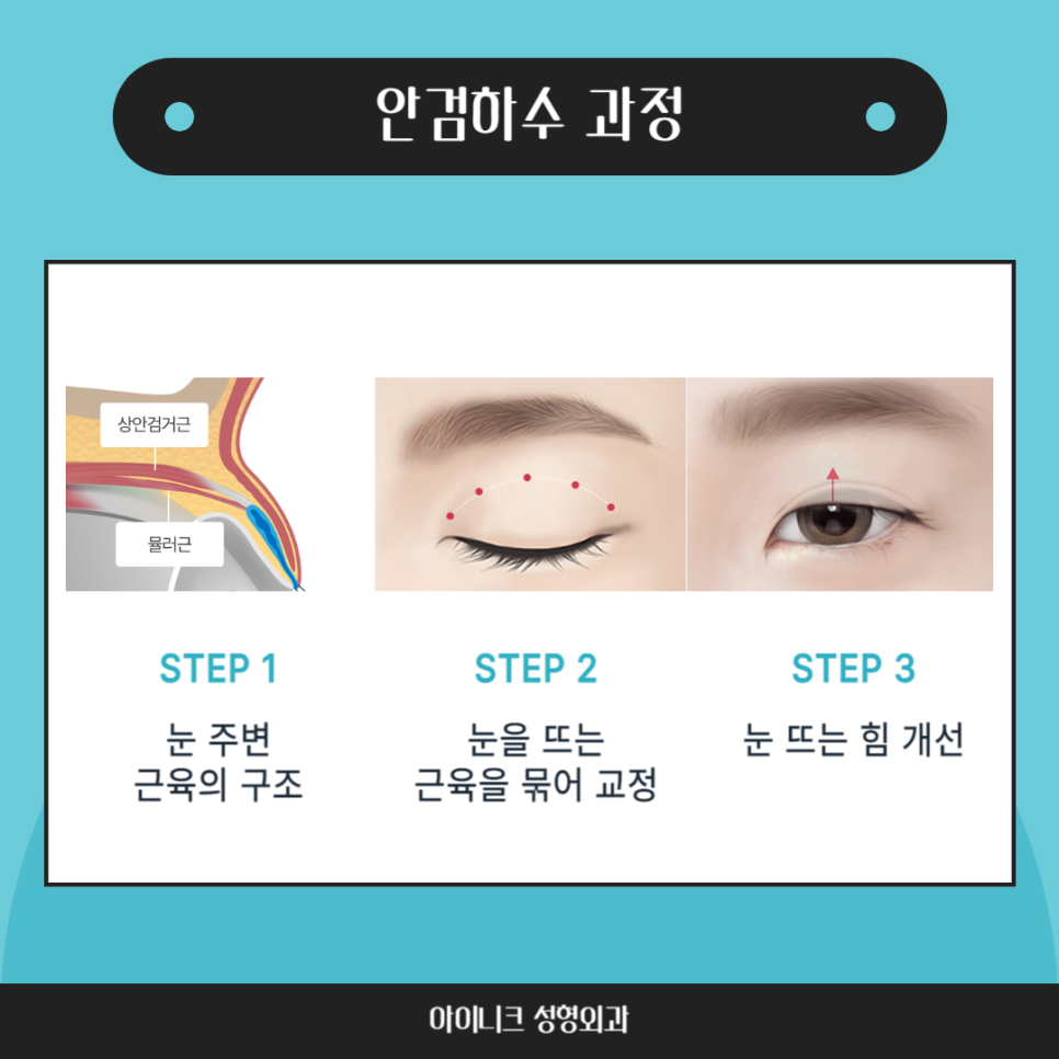 눈처짐 수술, 일반 쌍수랑 무엇이 다를까? 관련 이미지 4