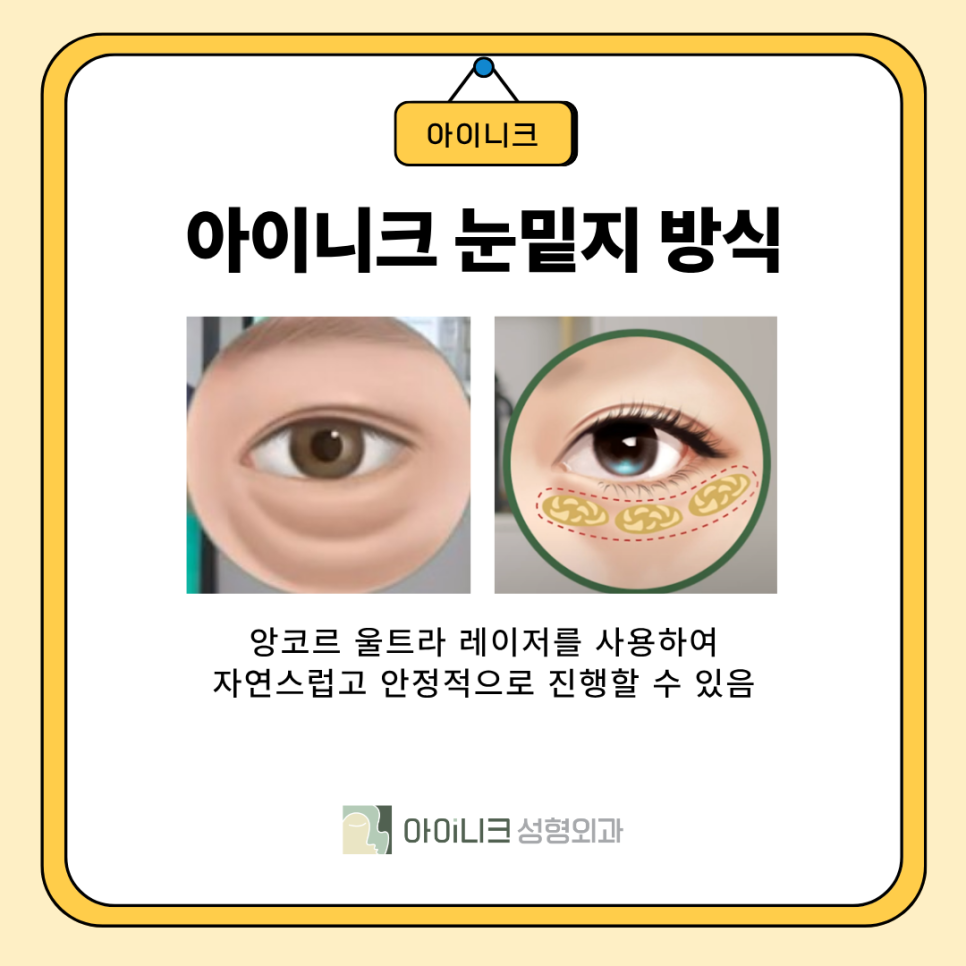 앙코르 눈밑지 레이저 일반적인 방식과 차이점 관련 이미지 5