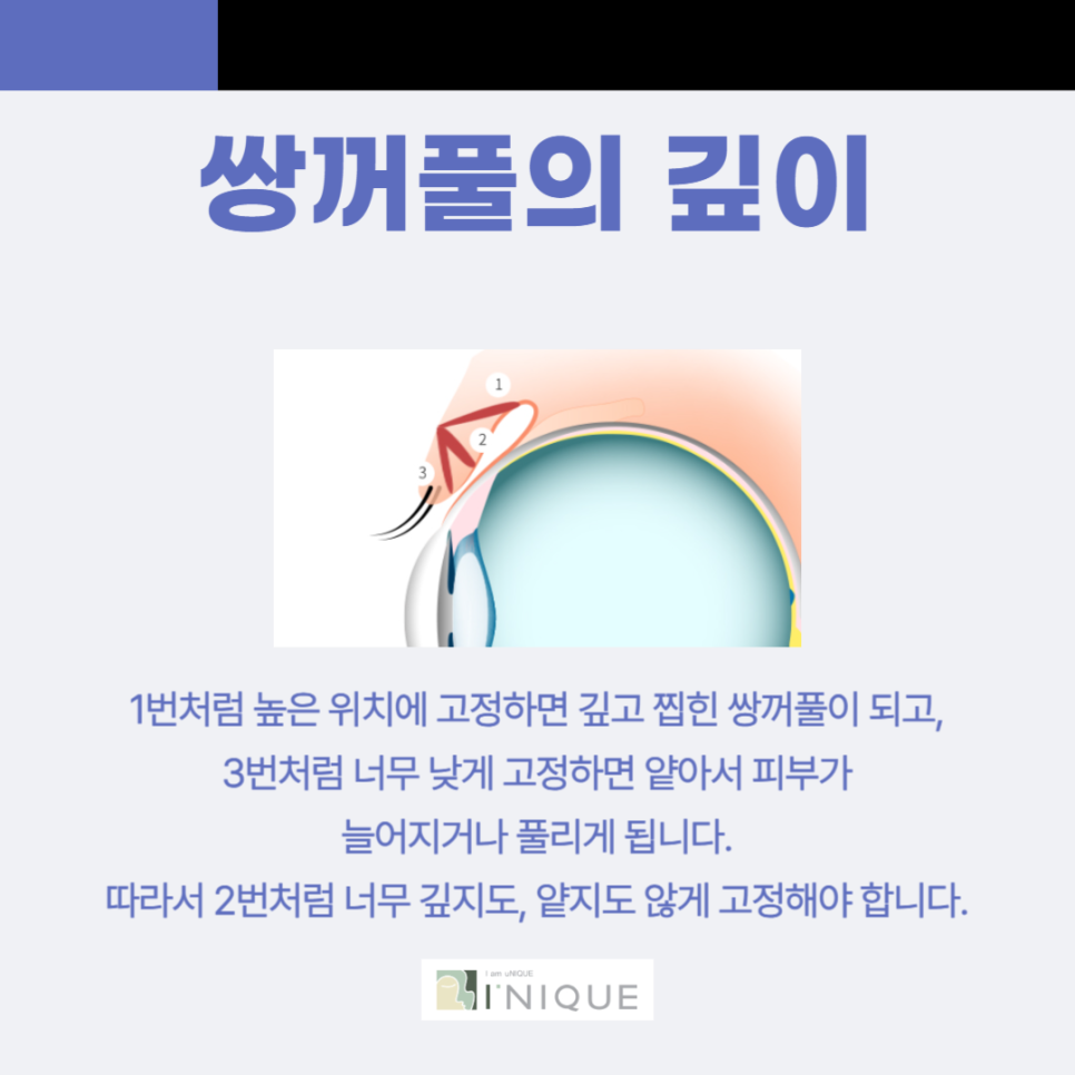 압구정 쌍수잘하는곳 아이니크 관련 이미지 4