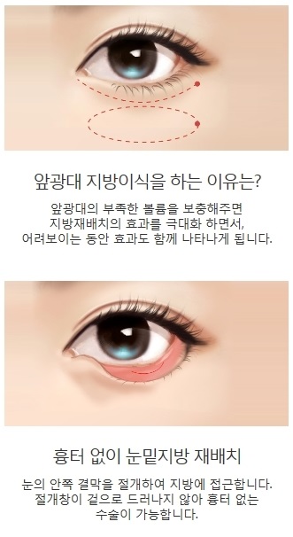 다크서클수술비용 걱정 없이 환한 얼굴로 변신! 관련 이미지 4