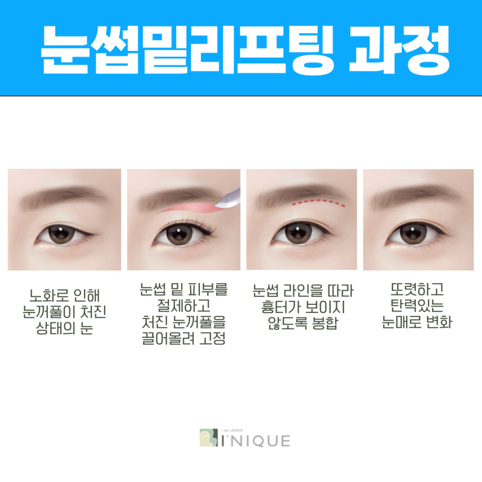 중년성형외과 안전함과 완성도를 갖춘 이곳 관련 이미지 4