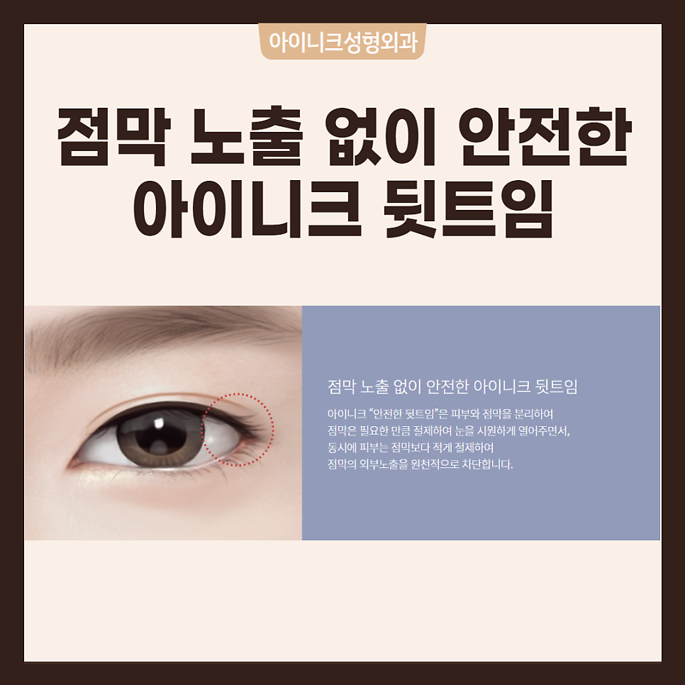 다양한 트임수술 같이 알아봐요! 관련 이미지 5
