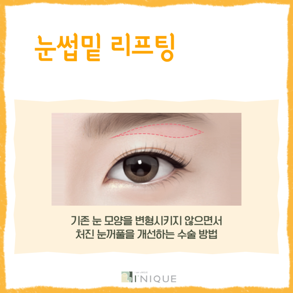 Have You Heard About Middle-Age Eye Rejuvenation Surgery? image 3