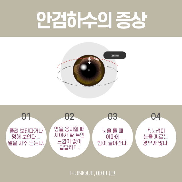 안검하수재수술은 어디서? 관련 이미지 2