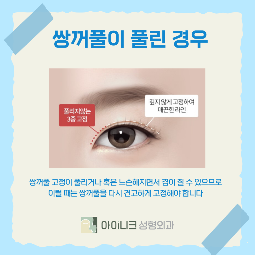 Best Clinic for Double Eyelid Revision Surgery: When Multiple Creases Form image 7