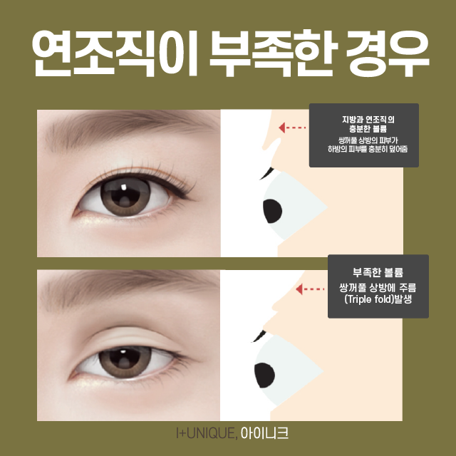 삼꺼풀해결방법, 원인 파악부터 제대로! 관련 이미지 4