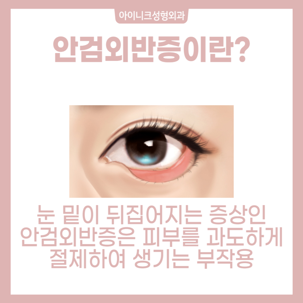 동안눈성형, 제대로 하고 싶다면 관련 이미지 6