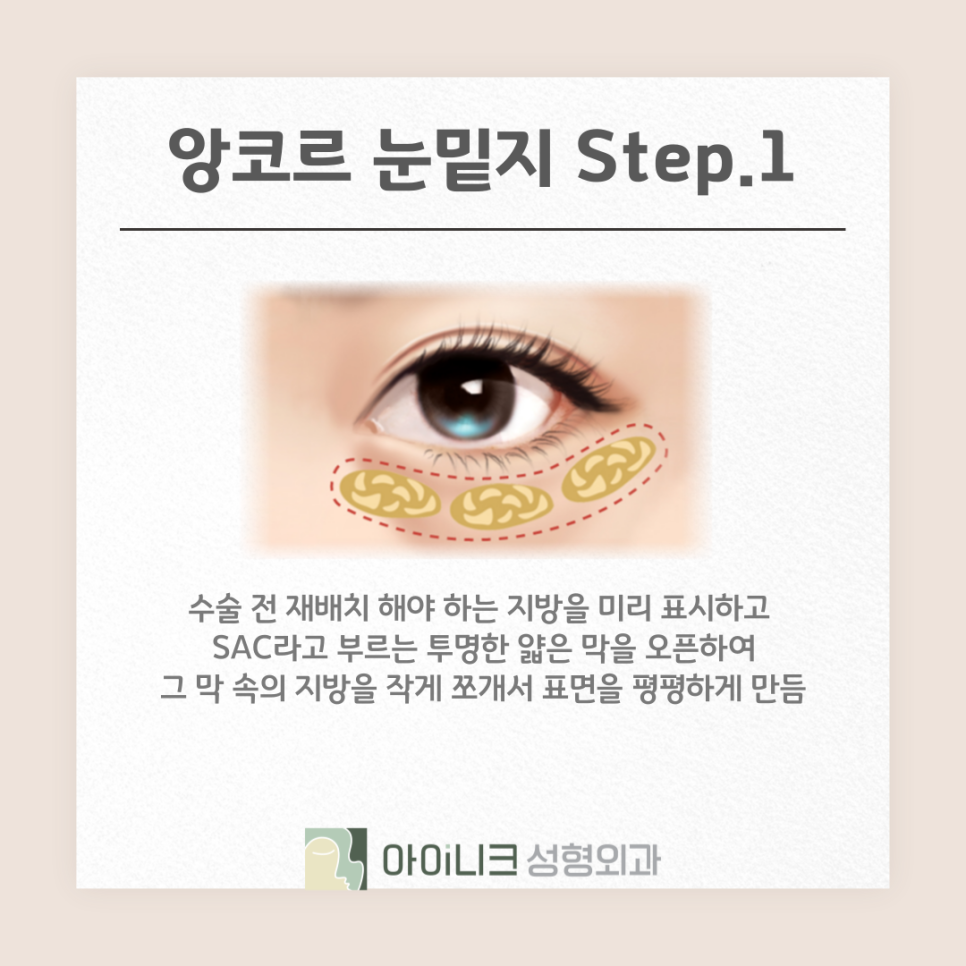 앙코르 눈밑지 효과 붓기 멍 적은 방법으로 관련 이미지 8