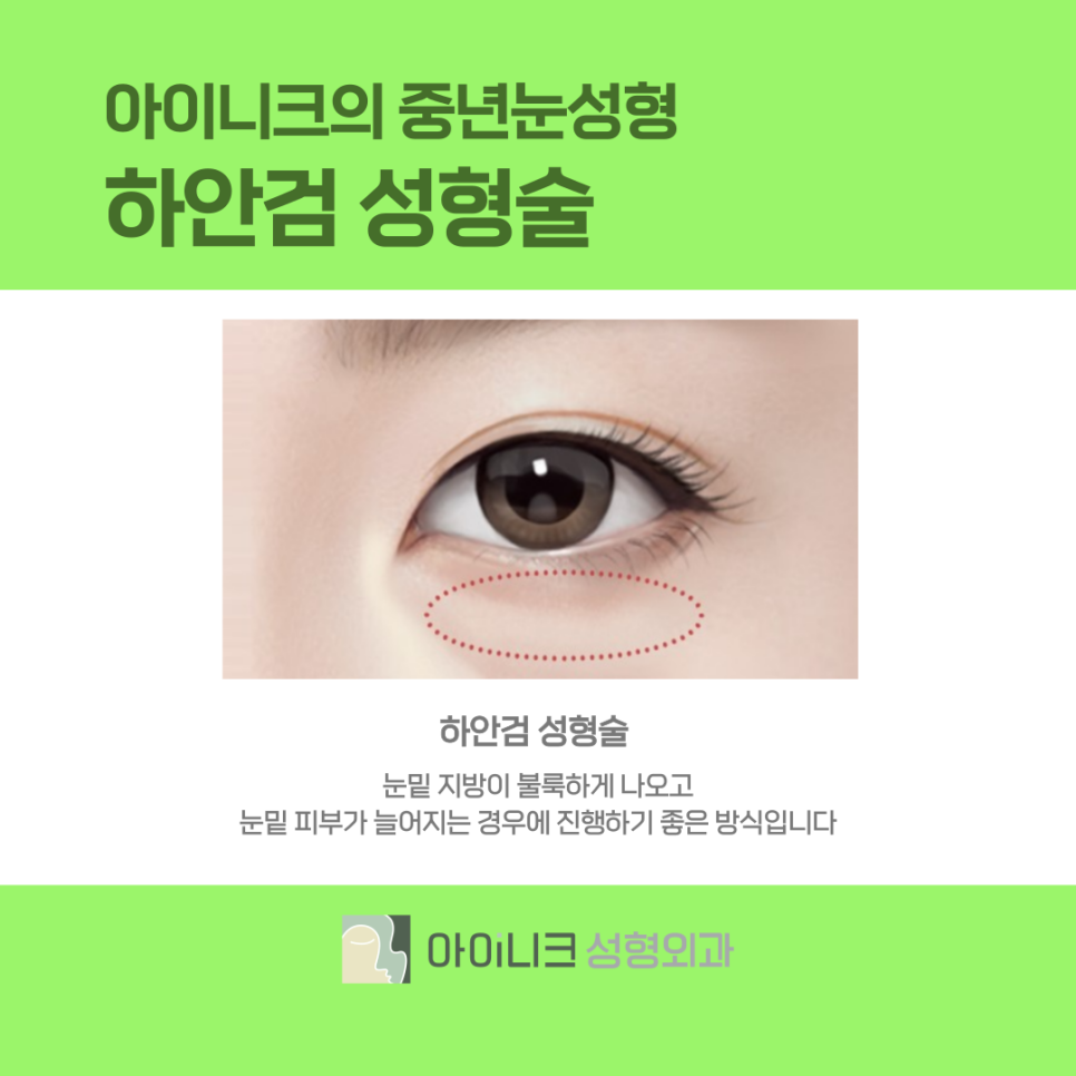 쌍수병원 잘하는곳에서 20대의 눈매로 돌아가기 관련 이미지 7
