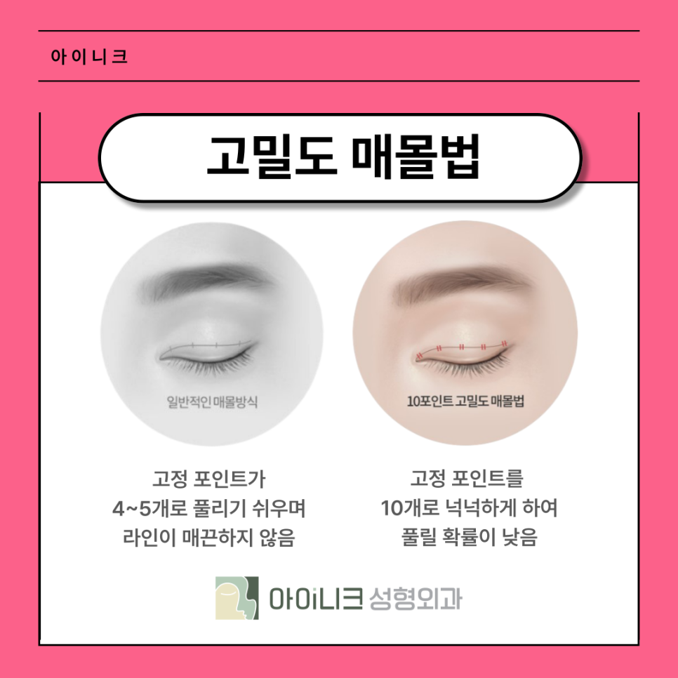 쌍꺼풀수술잘하는곳 풀릴 위험 낮은 매몰법은? 관련 이미지 6