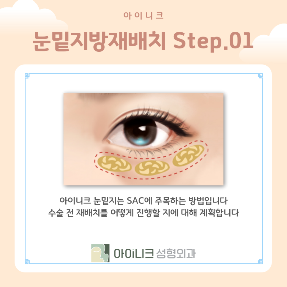 눈밑지방재배치가격만 중요할까? 관련 이미지 8