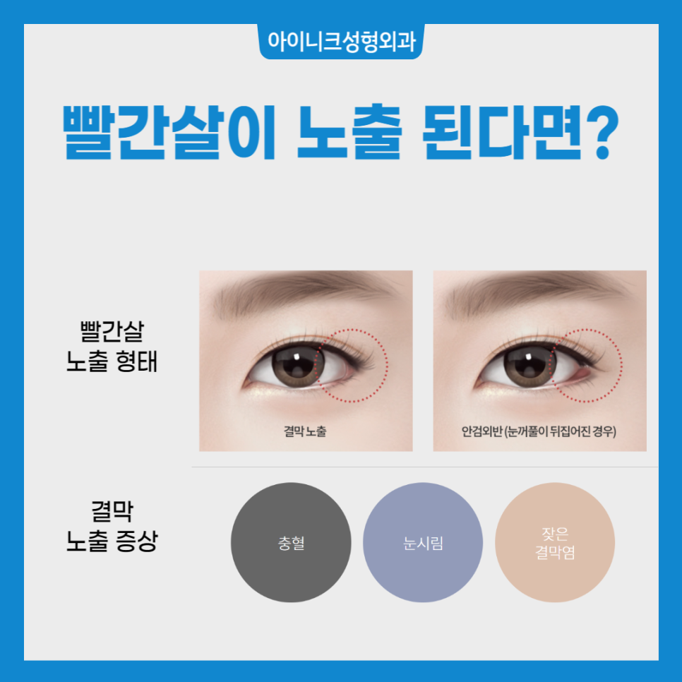 뒤트임 밑트임에 대해 알아보자! 관련 이미지 3