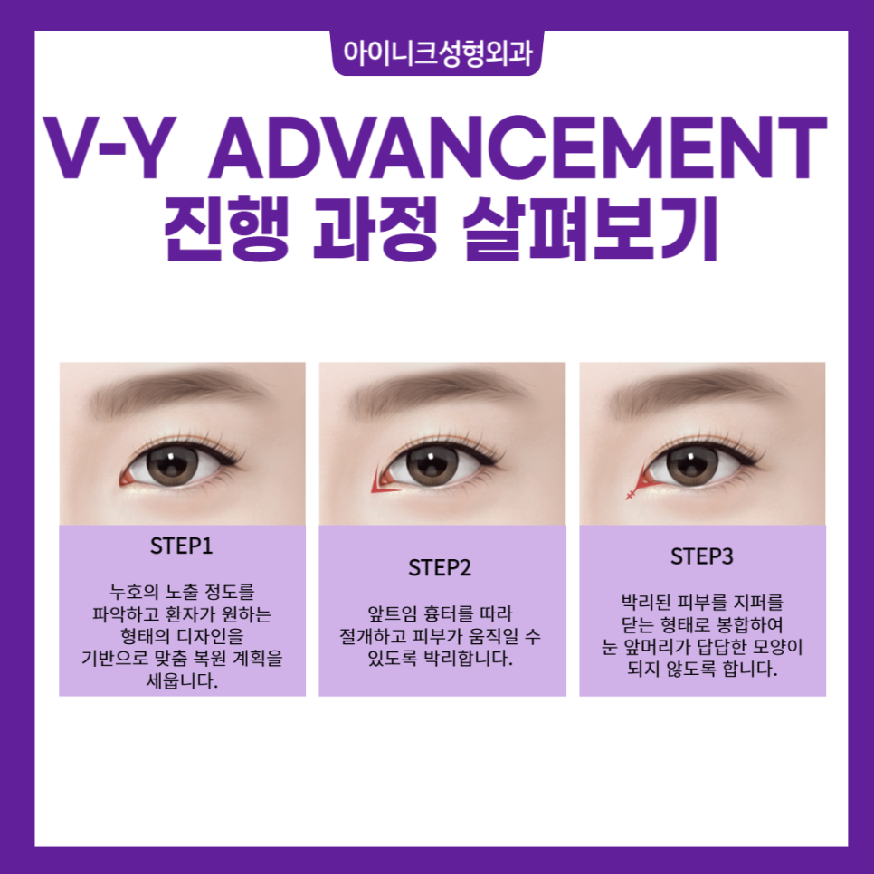 앞트임재수술잘하는곳, 여기! 관련 이미지 3