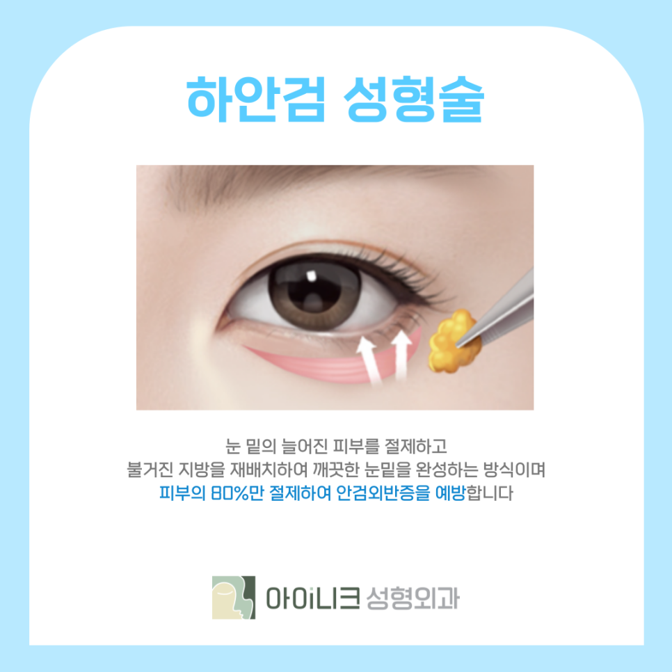 눈가리프팅 중년 눈성형으로 10년 어려보이기 관련 이미지 7