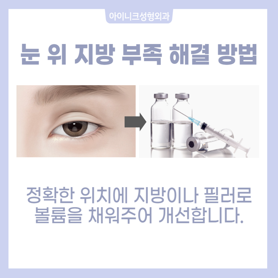 소세지눈재수술로 자연스러움을 되찾는 방법 관련 이미지 5