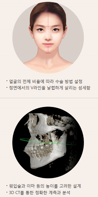 돌출입무턱필러 아이니크만의 자연스러움 관련 이미지 5
