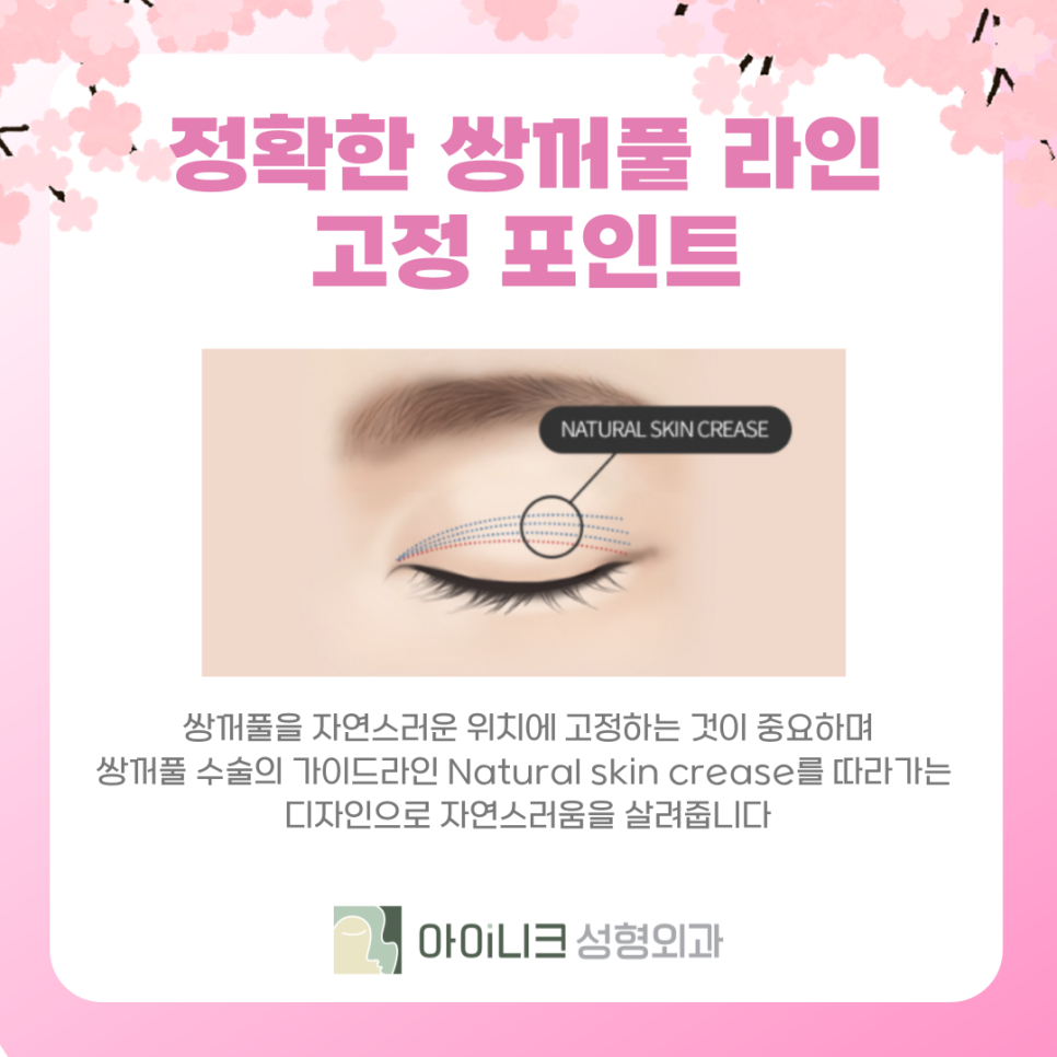 강남 쌍수 흉살 재수술이 필요한가요? 관련 이미지 6