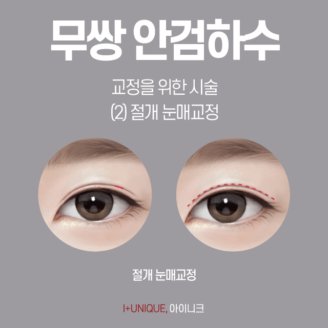 Where is the Most Natural Place to Improve Ptosis Without Double Eyelids? image 5