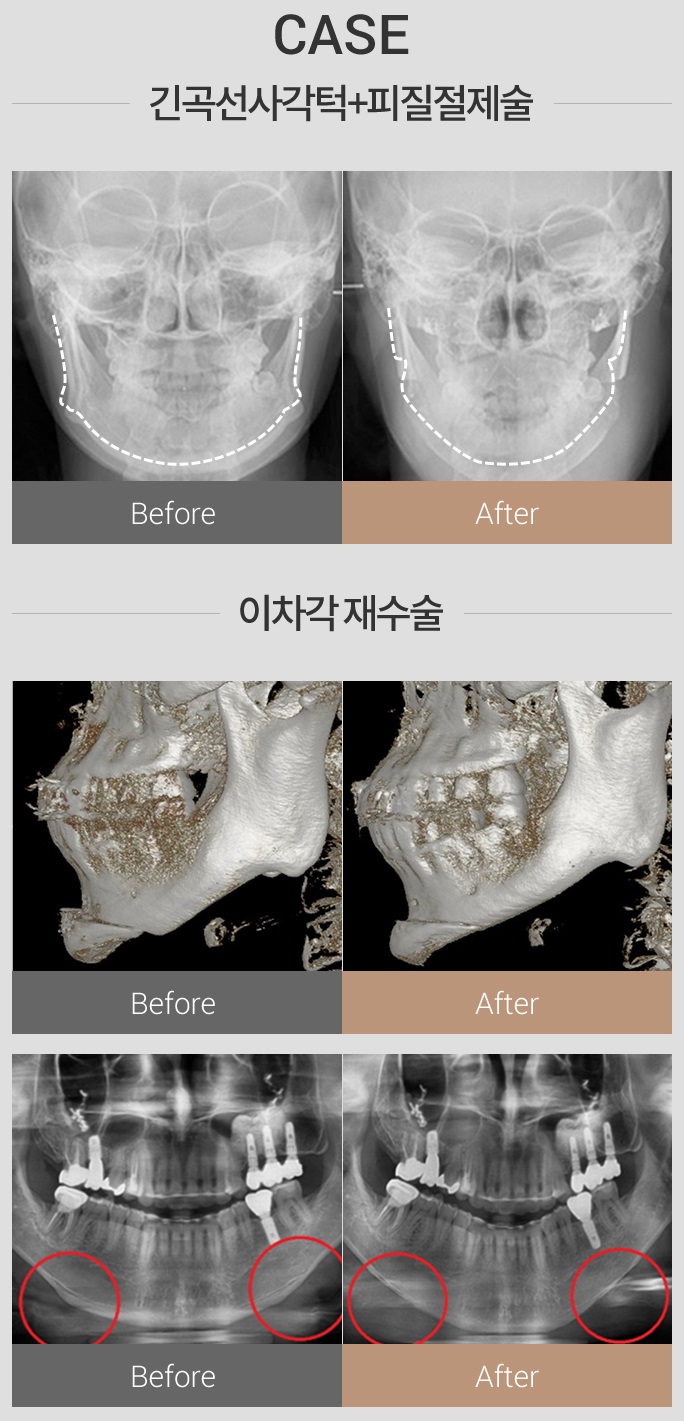 남자안면윤곽수술비용도 아이니크에서 알아보자! 관련 이미지 5