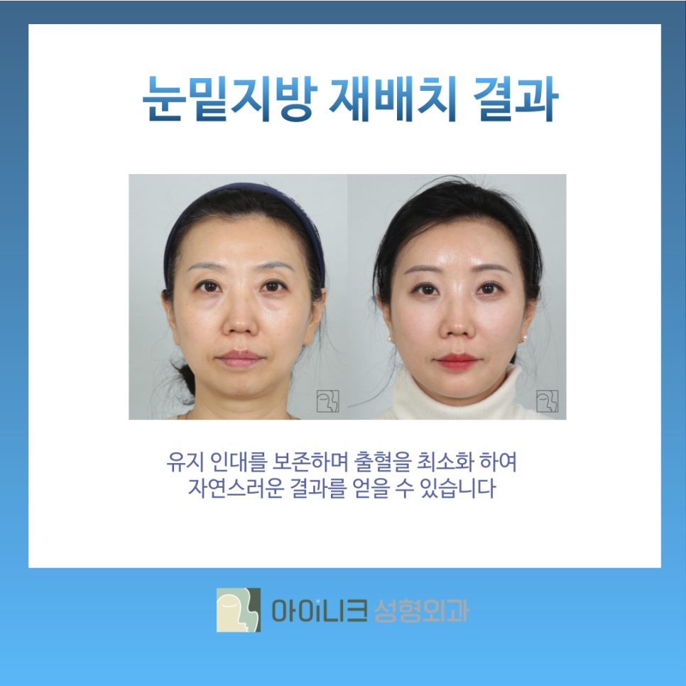 눈밑지방재배치효과 앙코르 눈밑센터에서 개선하기 관련 이미지 7