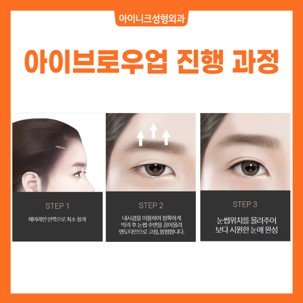 Beautiful Facial Balance with Brow Lift Surgery Recommendations! image 4
