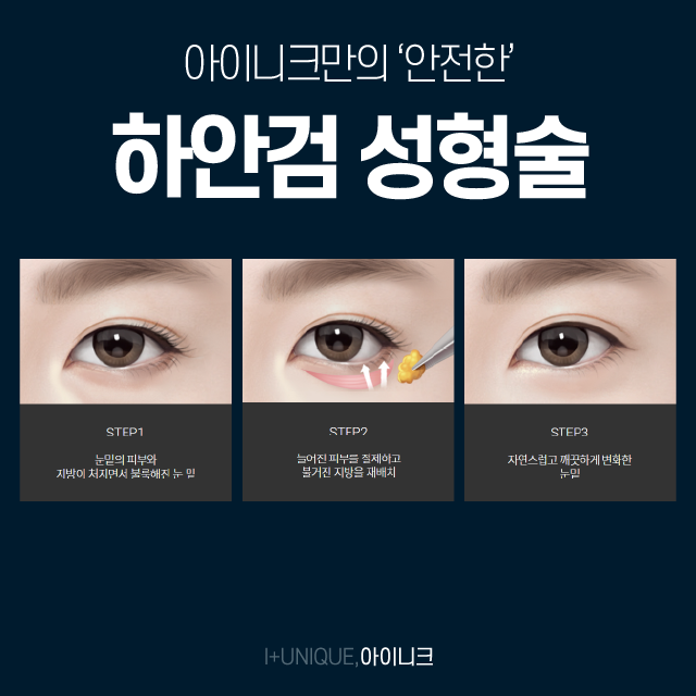 중년눈매교정 자연스러운 아름다움이 가장 좋습니다. 관련 이미지 4