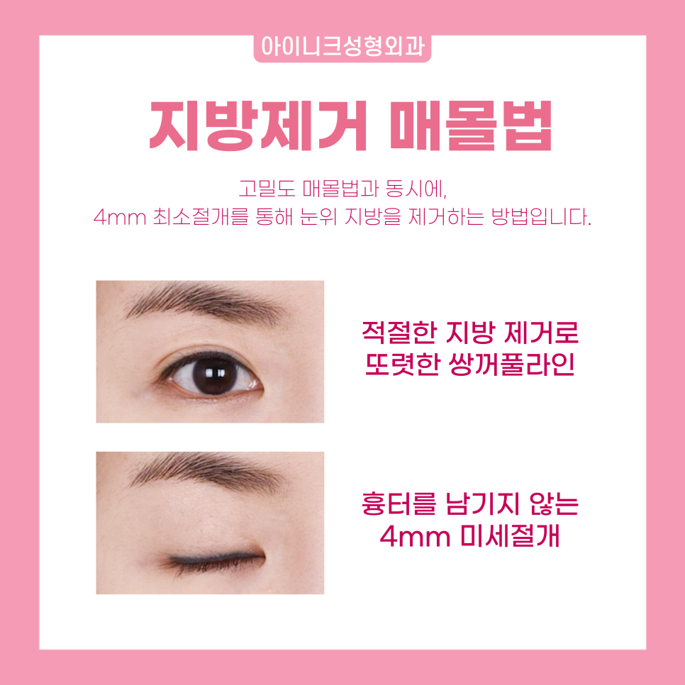 연예인눈성형을 원한다면 눈 성형 전문의에게! 관련 이미지 6