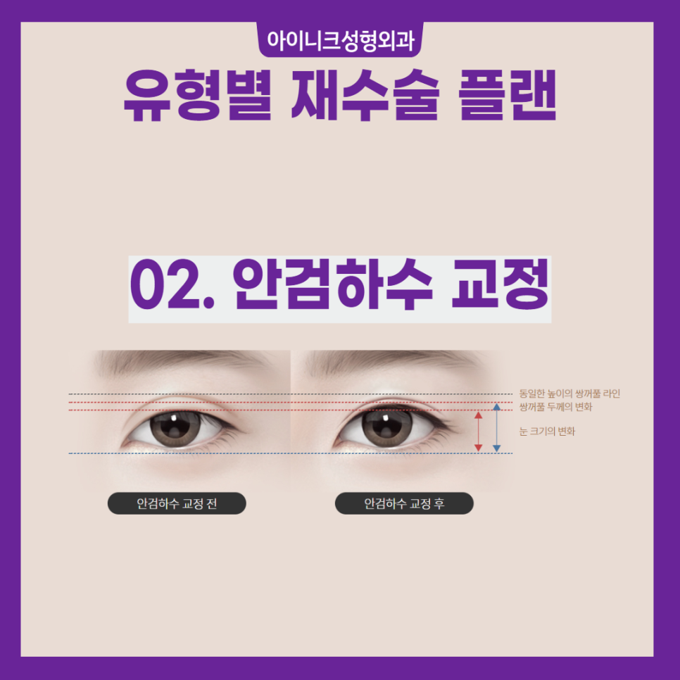 실패 없는 압구정눈성형 재수술 플랜 관련 이미지 4