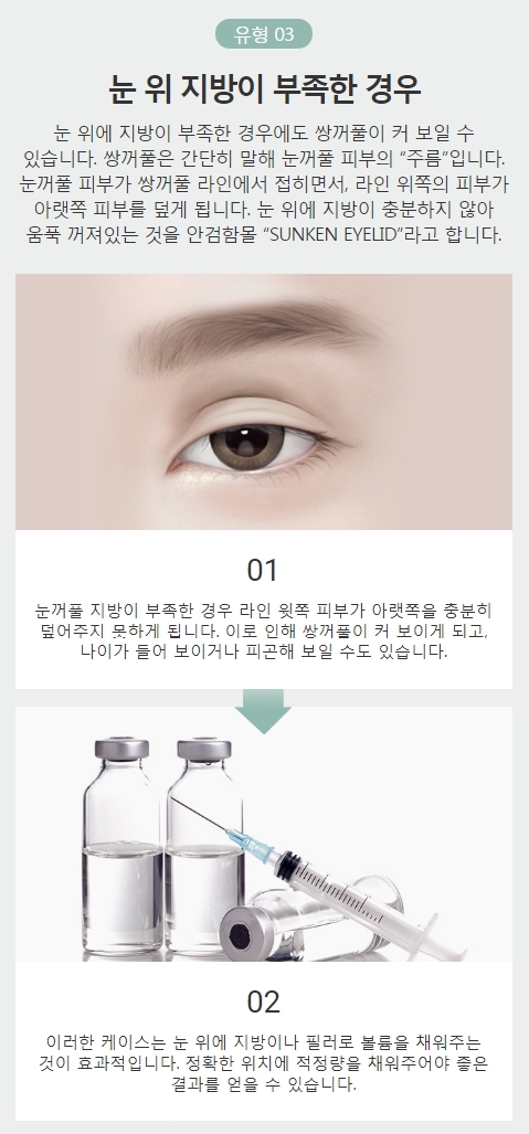 쌍커풀라인낮추기 아이니크 소시지 눈 재수술로 해결! 관련 이미지 5